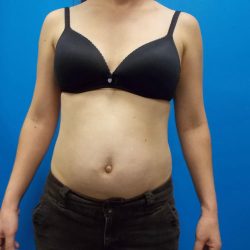 Tummy Tuck Before & After Patient #2140