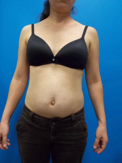Tummy Tuck Before & After Patient #2140