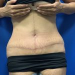 Tummy Tuck Before & After Patient #2141
