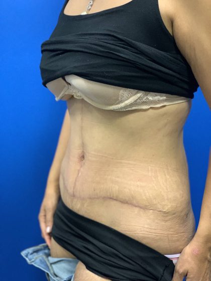 Tummy Tuck Before & After Patient #2141