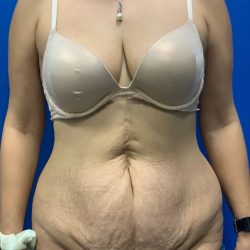 Tummy Tuck Before & After Patient #2141