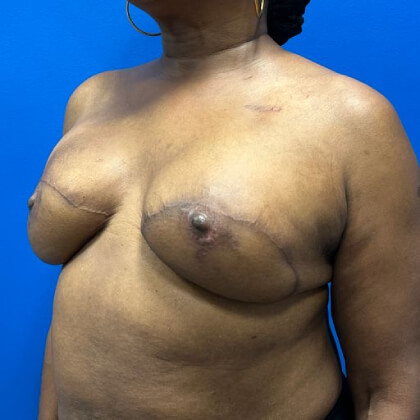 Latissimus Flap with Implant Before & After Patient #2717
