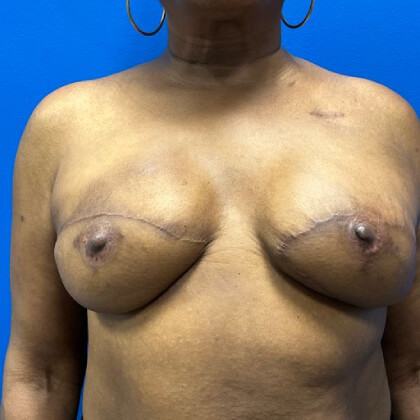 Latissimus Flap with Implant Before & After Patient #2717