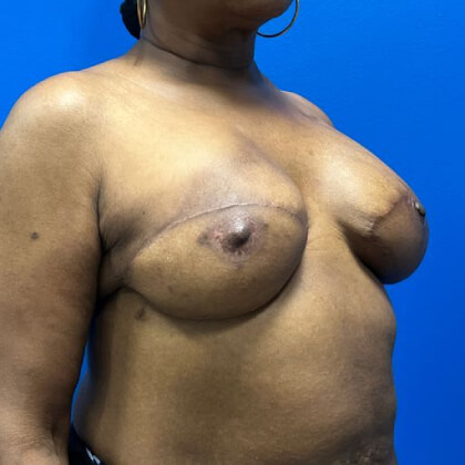 Latissimus Flap with Implant Before & After Patient #2717