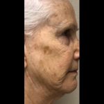 CO2 Laser Before & After Patient #2626