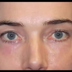 CO2 Laser Before & After Patient #2599