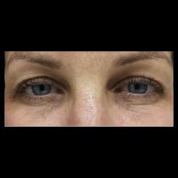CO2 Laser Before & After Patient #2634