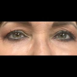 CO2 Laser Before & After Patient #2644
