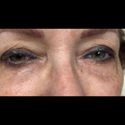 CO2 Laser Before & After Patient #2644