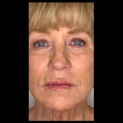 CO2 Laser Before & After Patient #2614