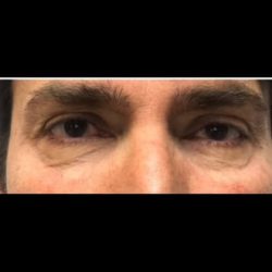 CO2 Laser Before & After Patient #2637