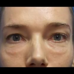 CO2 Laser Before & After Patient #2599