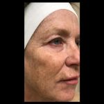 CO2 Laser Before & After Patient #2614