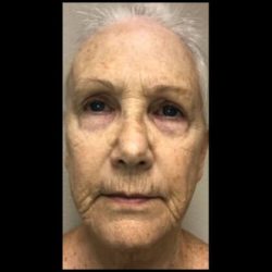 CO2 Laser Before & After Patient #2626