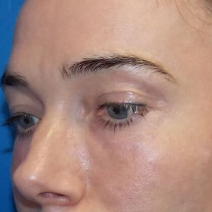 CO2 Laser Before & After Patient #2599