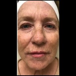 CO2 Laser Before & After Patient #2614