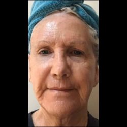 CO2 Laser Before & After Patient #2626