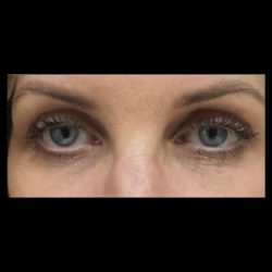 CO2 Laser Before & After Patient #2634