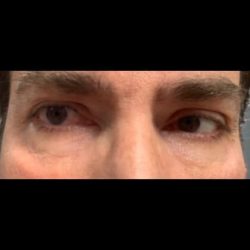 CO2 Laser Before & After Patient #2637