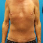 Body Contouring Before & After Patient #2992