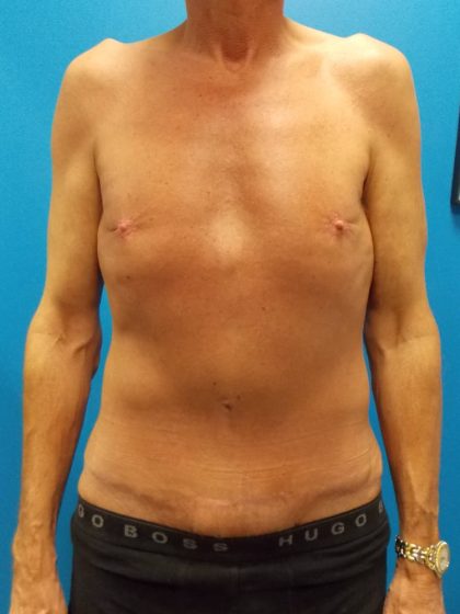Body Contouring Before & After Patient #2992