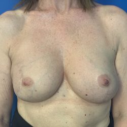 Local Flap Breast Reconstruction Before & After Patient #2911