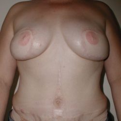 TRAM Flap Breast Reconstruction Before & After Patient #2561