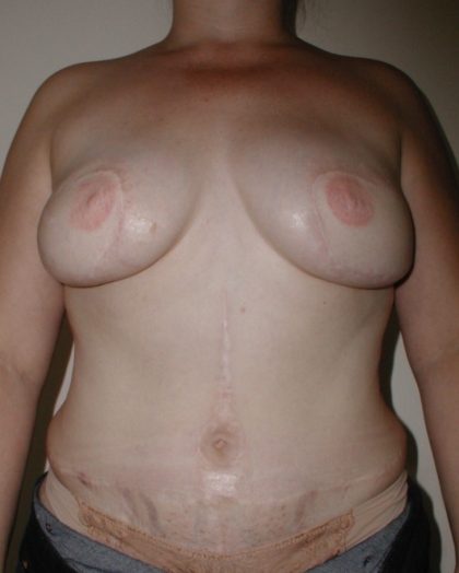 TRAM Flap Breast Reconstruction Before & After Patient #2561