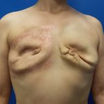 Latissimus Flap with Implant Before & After Patient #2709