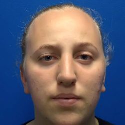 Rhinoplasty Before & After Patient #2529