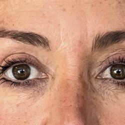 Upper Blepharoplasty Before & After Patient #2655