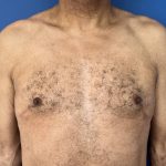 Gynecomastia Before & After Patient #2346