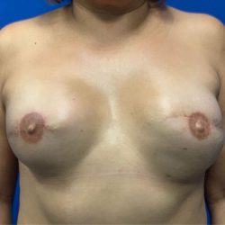 Tissue Expander To Implant Breast Reconstruction Before & After Patient #2511