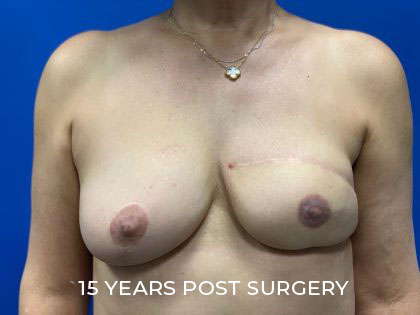 TRAM Flap Breast Reconstruction Before & After Patient #2480