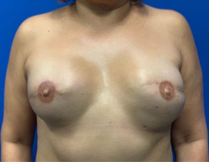 Tissue Expander To Implant Breast Reconstruction Before & After Patient #2511