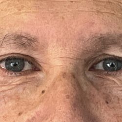 Upper Blepharoplasty Before & After Patient #3055