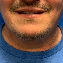 Submental Liposuction Before & After Patient #2892