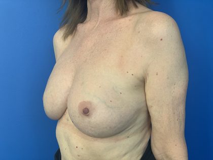 Local Flap Breast Reconstruction Before & After Patient #2911