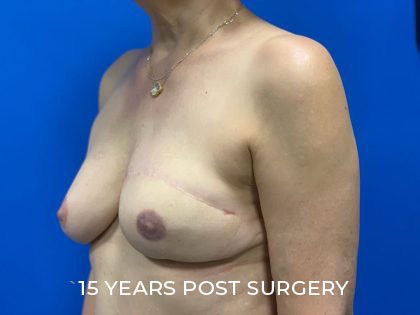 TRAM Flap Breast Reconstruction Before & After Patient #2480