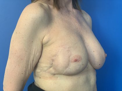 Local Flap Breast Reconstruction Before & After Patient #2911