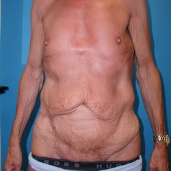 Body Contouring Before & After Patient #2992