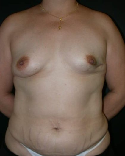 TRAM Flap Breast Reconstruction Before & After Patient #2561
