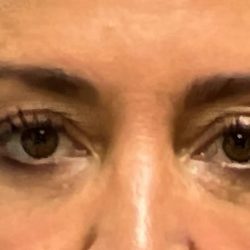 Upper Blepharoplasty Before & After Patient #2655