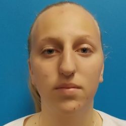 Rhinoplasty Before & After Patient #2529