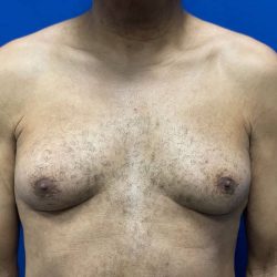 Gynecomastia Before & After Patient #2346