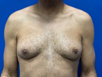 Gynecomastia Before & After Patient #2346