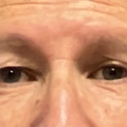 Upper Blepharoplasty Before & After Patient #3055