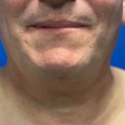 Submental Liposuction Before & After Patient #2892