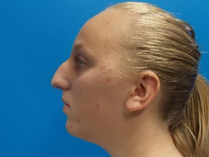 Rhinoplasty Before & After Patient #2529