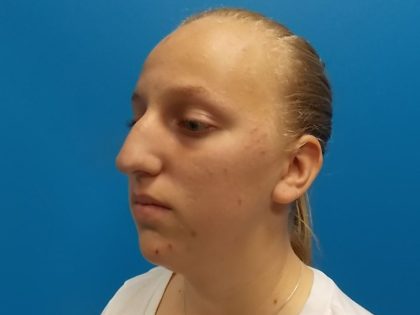Rhinoplasty Before & After Patient #2529